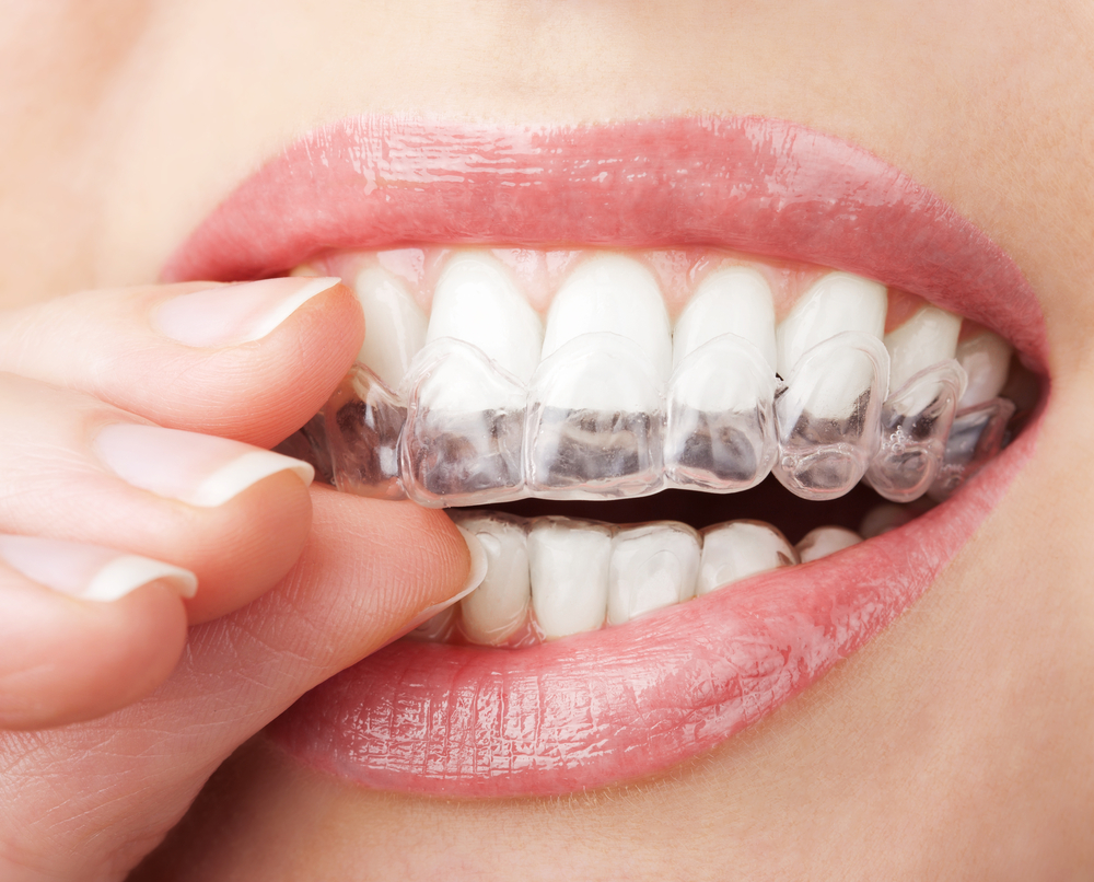 Invisible braces for adults in Barcelona - Turó Park Clinics